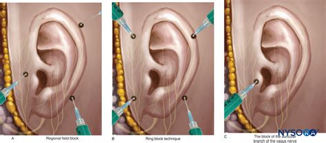 Posterior Auricular Nerve Block