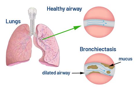 Bronchiectasis - Saint John’s Cancer Institute