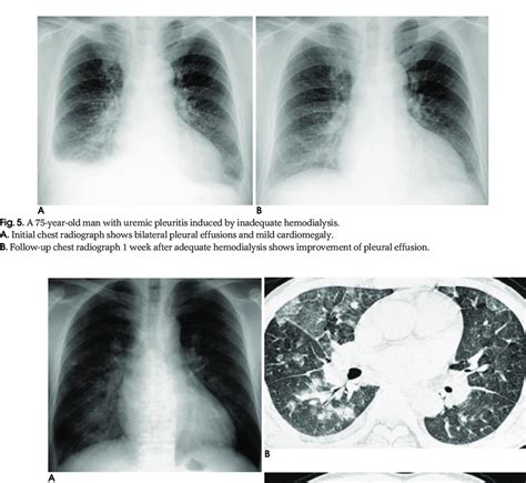 A 41-year-old man with end stage renal disease and pulmonary ...