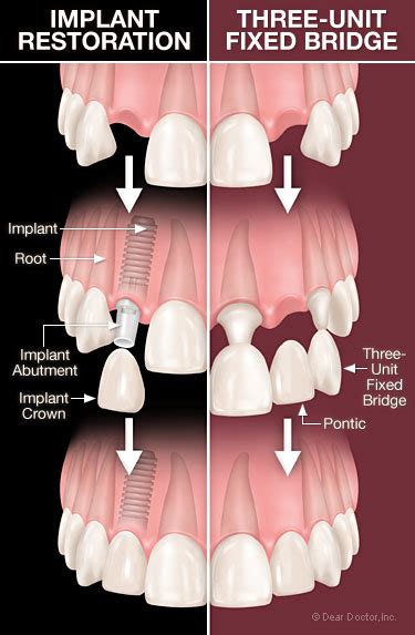 Dental Bridge Abutment