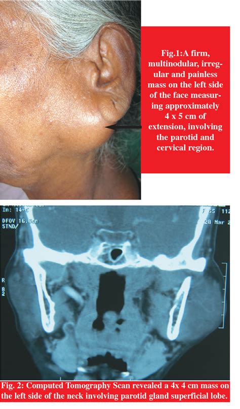 Figure 2 from PLEOMORPHIC ADENOMA OF PAROTID GLAND A Case Report ...