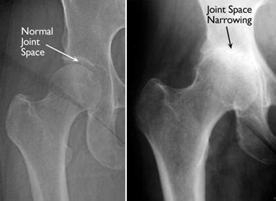 Inflammatory Arthritis of the Hip - OrthoInfo - AAOS