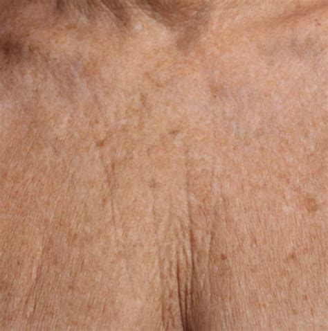 Neck/Chest And Aged Skin | Faciem Dermatology Clinic