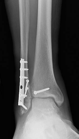 Tibia And Fibula Ankle Fracture