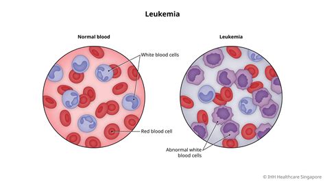 Leukemia (Blood Cancer) - Symptoms & Causes | Gleneagles Hospital