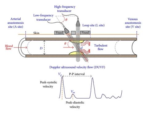 (a) Arteriovenous shunt and its measurement sites, (b) Doppler ...