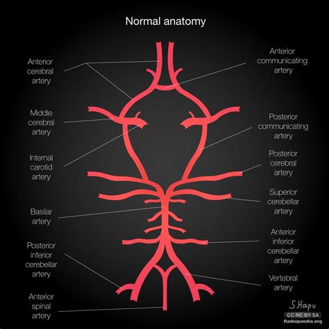 Common variants of the circle of Willis: diagrams | Radiology Case ...