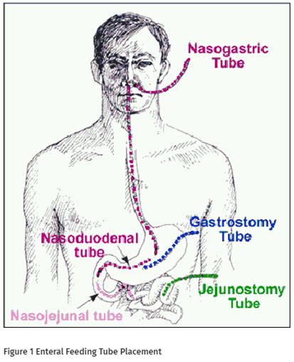 Nj feeding tube