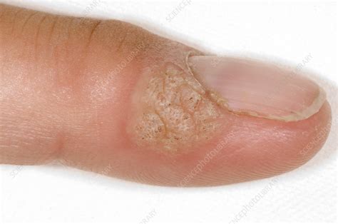 Common warts - Stock Image - M290/0162 - Science Photo Library