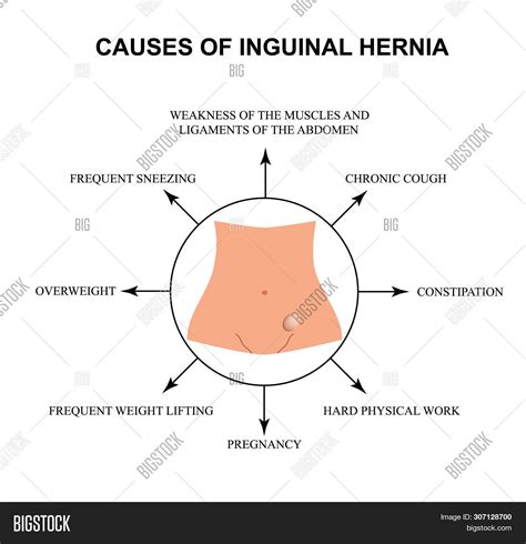 Causes Inguinal Hernia Image & Photo (Free Trial) | Bigstock