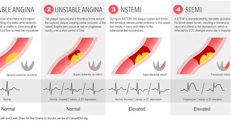 Stable Angina Vs Unstable Angina Ecg : Unstable Angina Pathophysiology ...