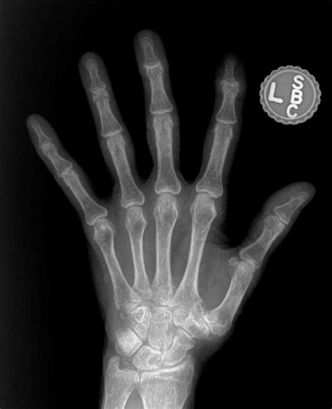 What does hand arthritis look like on x-ray? - John Erickson, MD