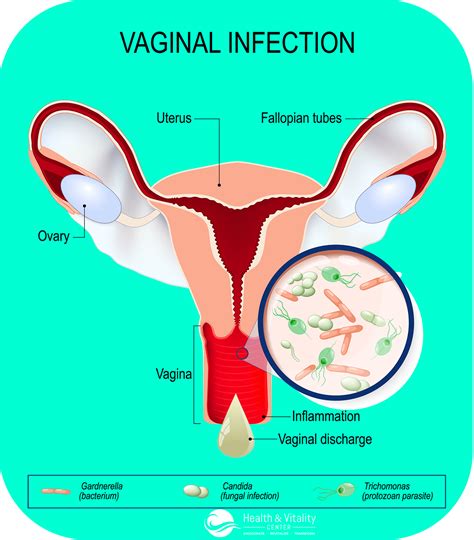 Vaginal Bacterial Infection Discharge