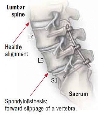 When is back surgery the right choice? - Harvard Health