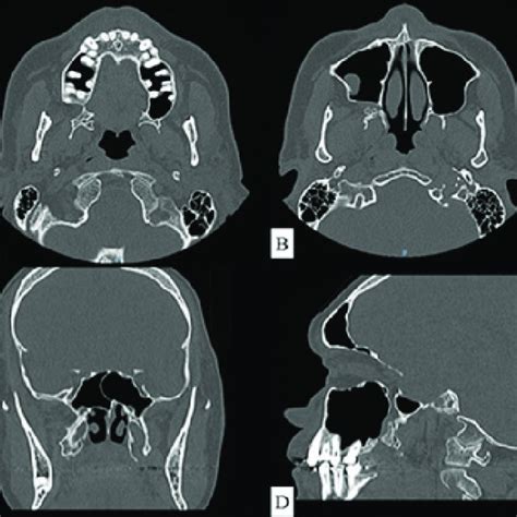 (PDF) Pterygoid process fracture during dental extraction - An unusual ...