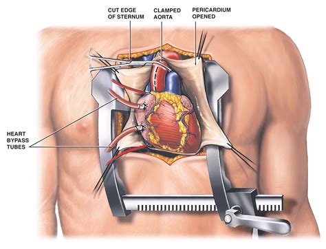 life after aortic valve replacement surgery - Delmy Sutter