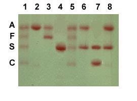 Hemoglobin Electrophoresis