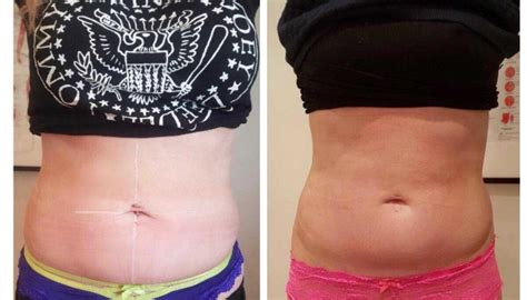 3D Lipo Results - My Journey so far - AJ Makeup