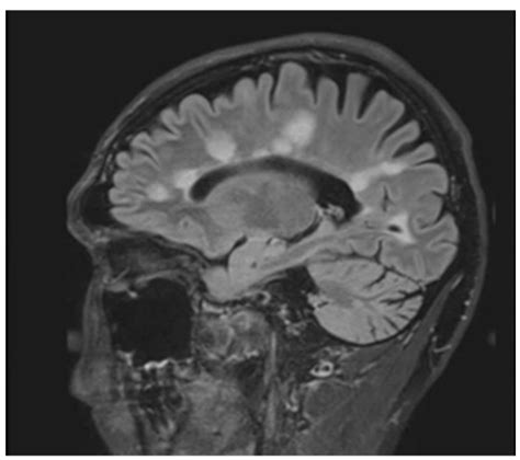 Lesions On Mri T Spine