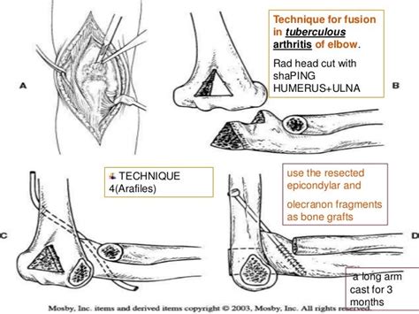 arthrodesis