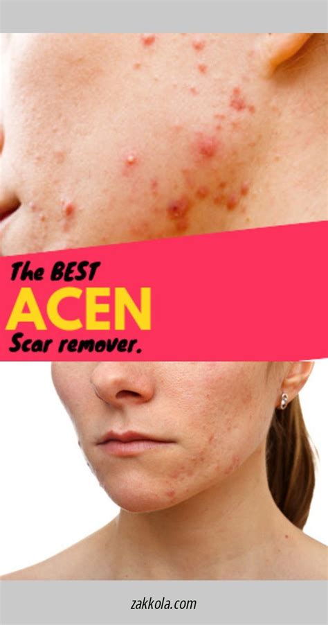 Nodular Acne: Causes Treatments And Prevention – EadvVienna2020.org