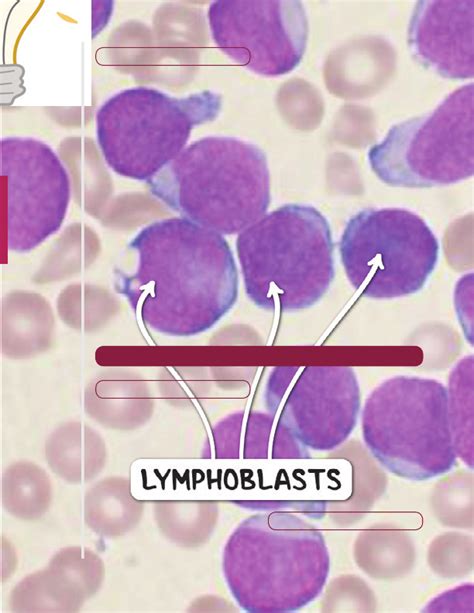 Acute leukemia | Osmosis