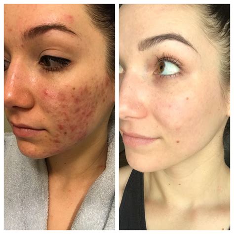 Before and 9 months after PDT and Spironolactone : r/acne