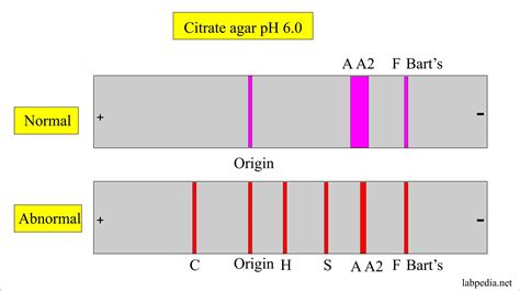 Hemoglobin Electrophoresis Results