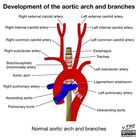 Radiopaedia - Drawing Aortic arch and its branches - English labels ...