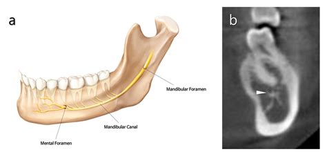 Mandibular Foramen