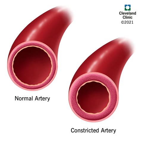 Vasoconstriction: What Is It, Symptoms, Causes & Treatment