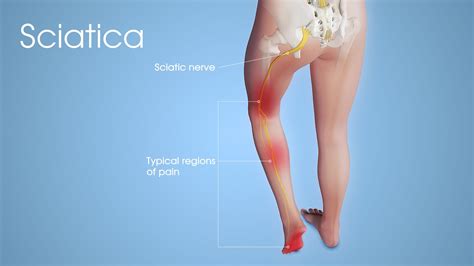 Sciatica: Causes, Pathophysiology, Management and Treatment