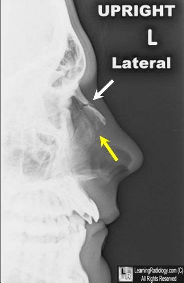 Nasal fractures may not be evident on plain films One suture line ...