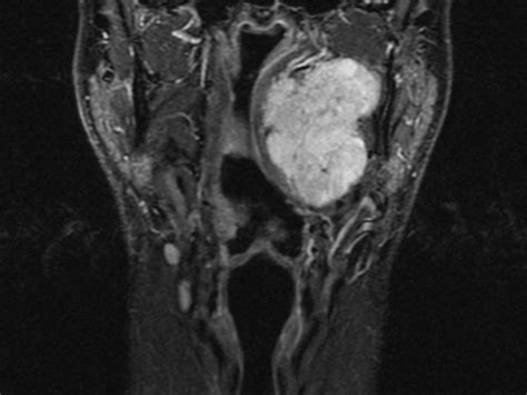 Pleomorphic adenoma MRI - wikidoc