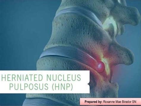 Herniated Nucleus Pulposus