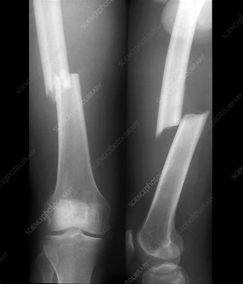 Fractured femoral shaft, X-rays - Stock Image - C040/3064 - Science ...