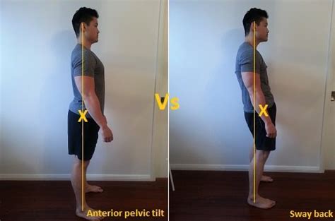 How To Fix Sway Back Posture - Posture Direct