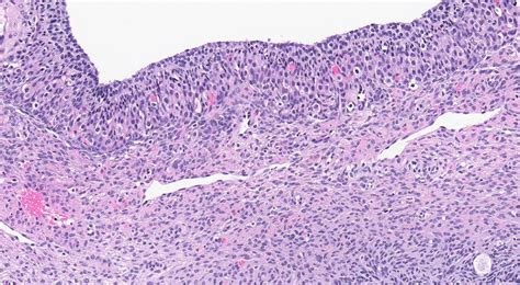 Ovarian Cyst Histology