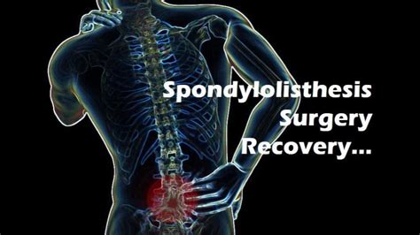 What Does Spondylolisthesis Surgery Recovery Look Like?