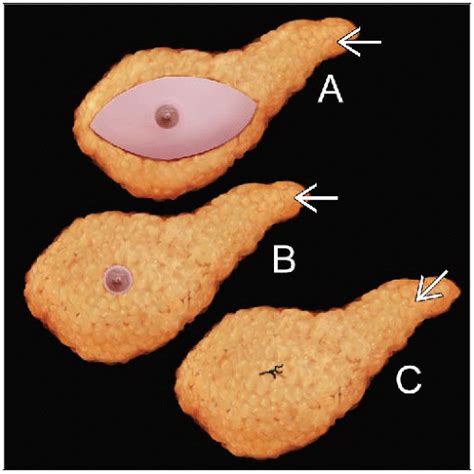 Mastectomies | Basicmedical Key