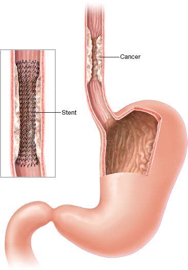 Esophageal Stents | Thoracic Key