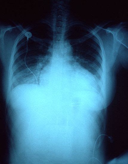 Lung congestion | medicine | Britannica.com