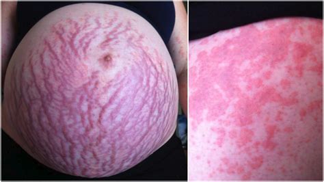 Pregnant mum’s rash covered her whole body: ‘The pain and the itch was ...