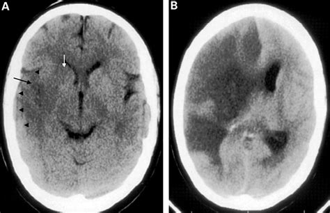 Ischemic Vs Hemorrhagic Stroke Mri