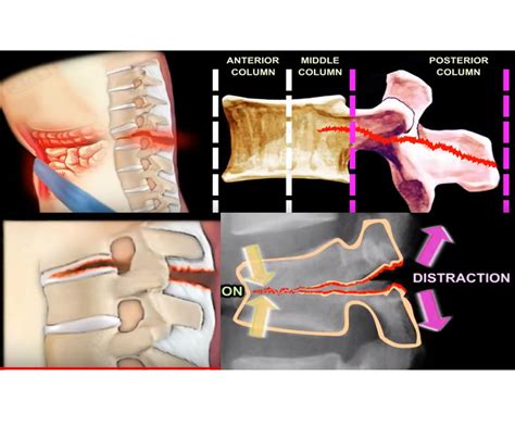 Flexion Distraction Injury of the Spine — OrthopaedicPrinciples.com