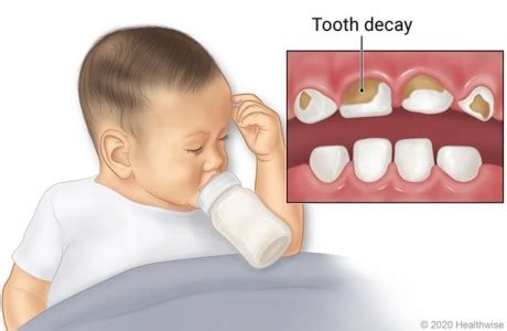 Baby Bottle Tooth Decay