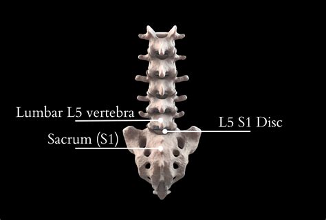 L5 S1 Disc Pain Treatment Options