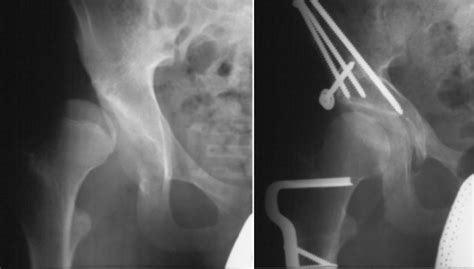 Periacetabular Osteotomy (PAO) for Acetabular Dysplasia - John C ...