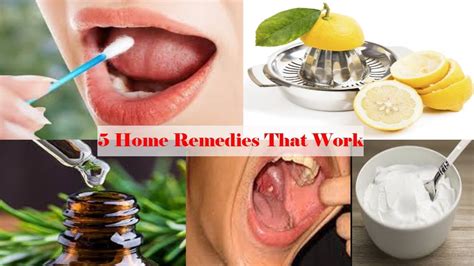 How Do You Remove Tonsil Stones - Tonsil stones (also called ...