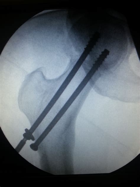 Femur Bone Fracture Surgery